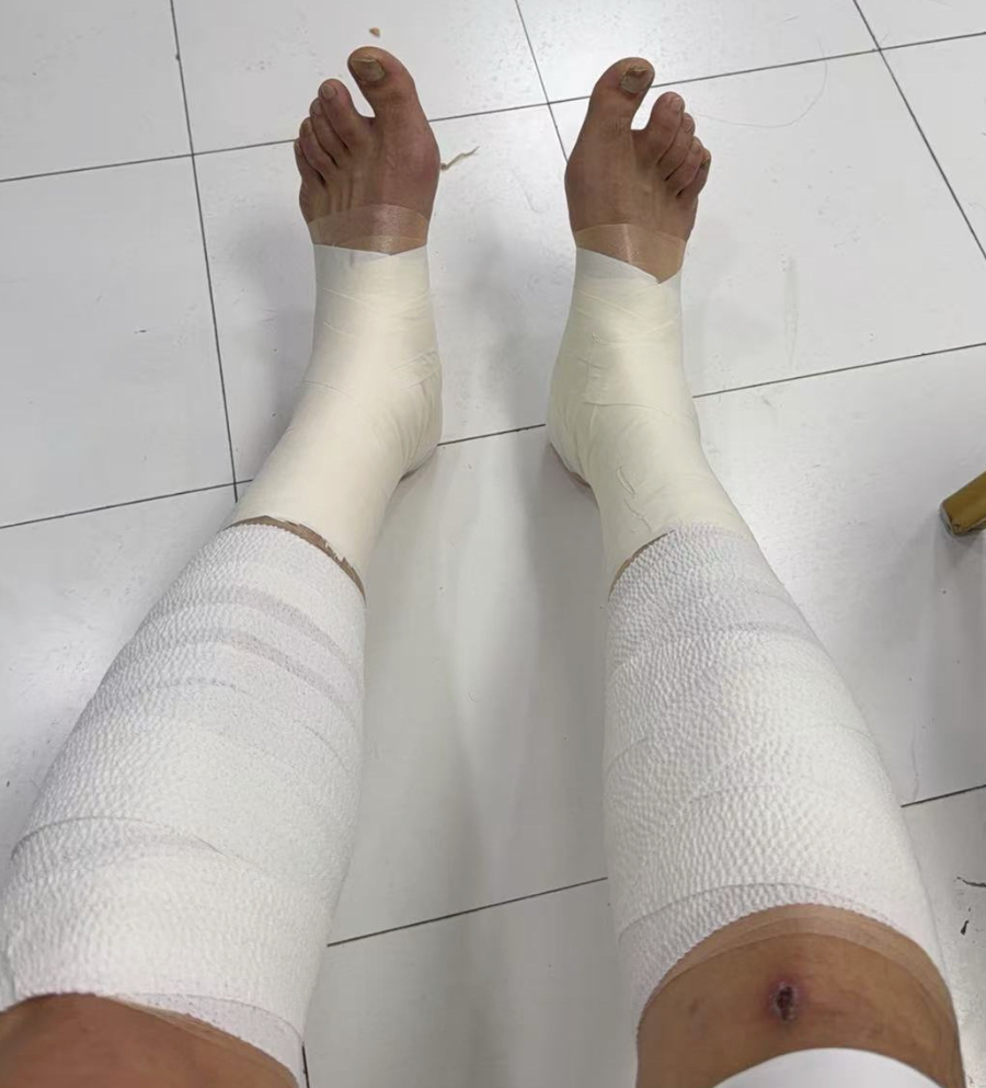 云开体育网站-胜山西谁注意翟晓川赛后伤势？双腿拉伤绑满绷带，看着都残忍！